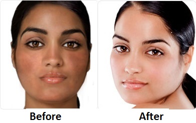 Skin Bleaching Cream Before and After