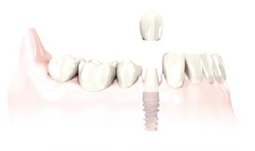 implant