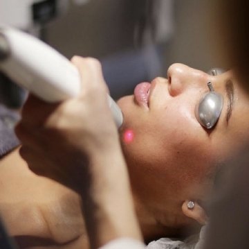 laser hair removal hounslow